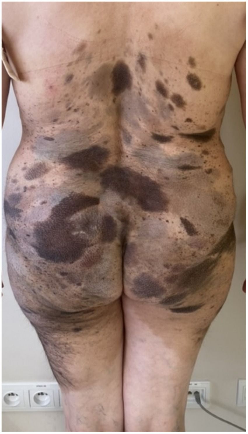 Isolated melanoma metastasis in a patient with large congenital nevus without detectable primary melanoma: a case report and review of literature