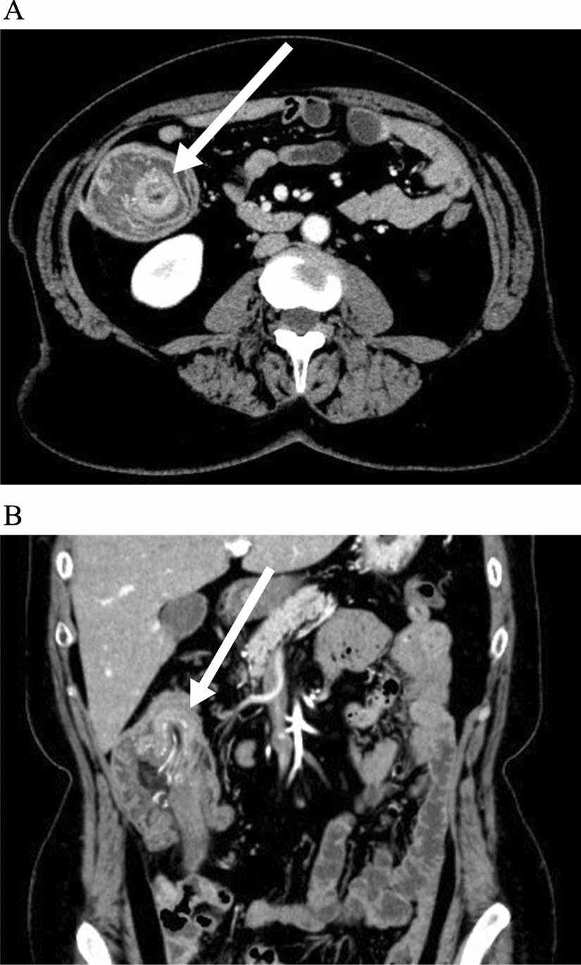 Intussusception of the appendix secondary to endometriosis: a case report