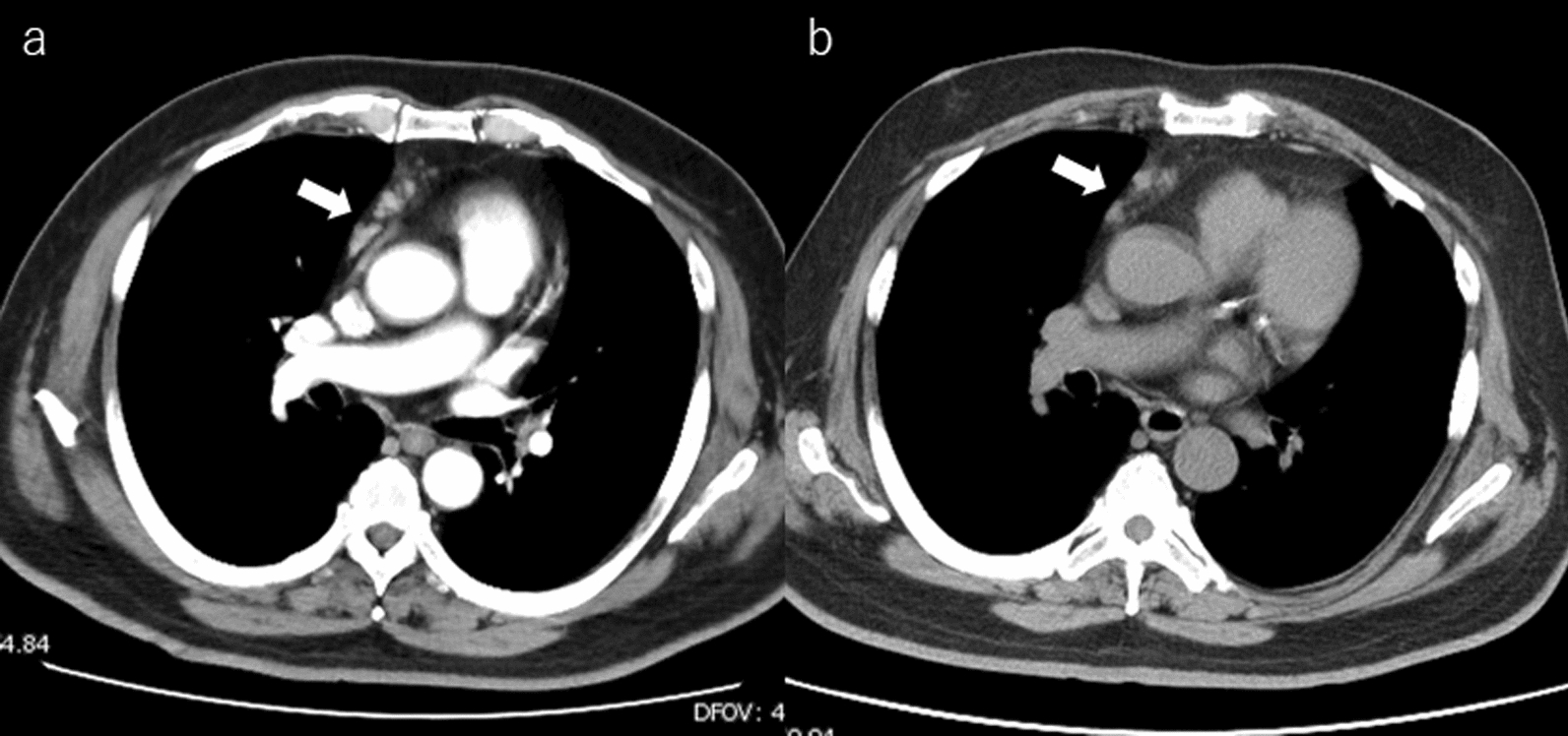 Hepatic methotrexate-associated lymphoproliferative disease: a case report and literature review