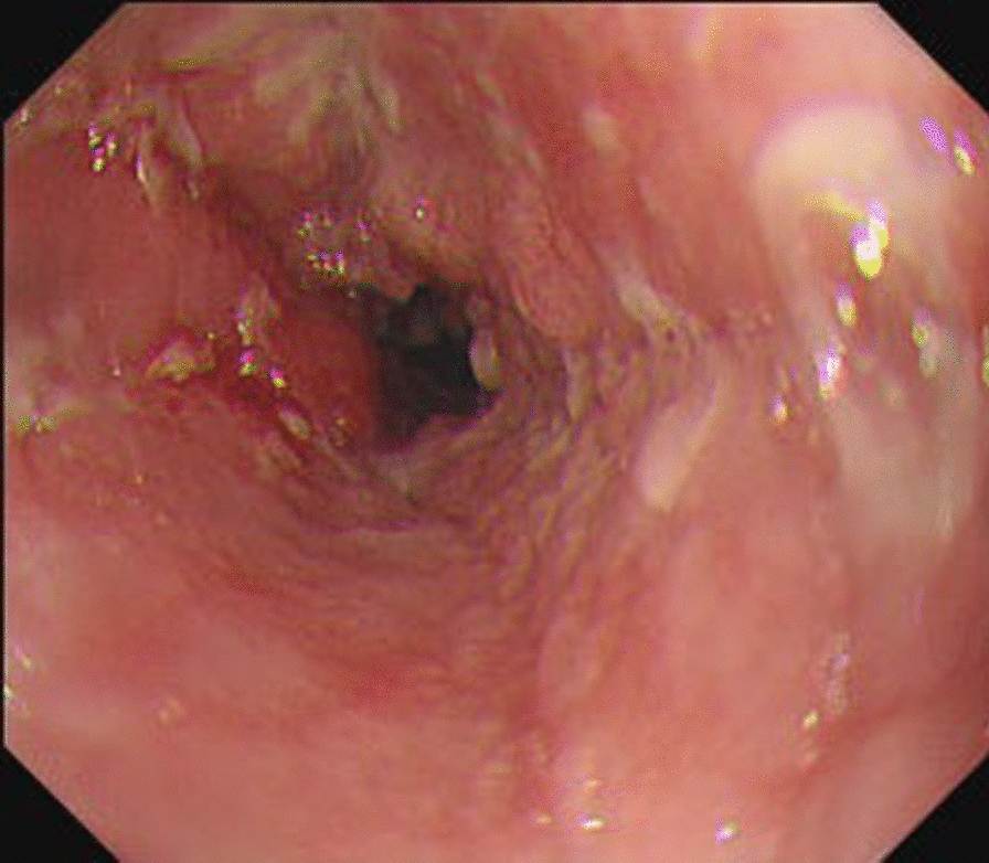 A case of intraoperative detection of a central venous catheter in azygos vein arch during esophageal cancer surgery