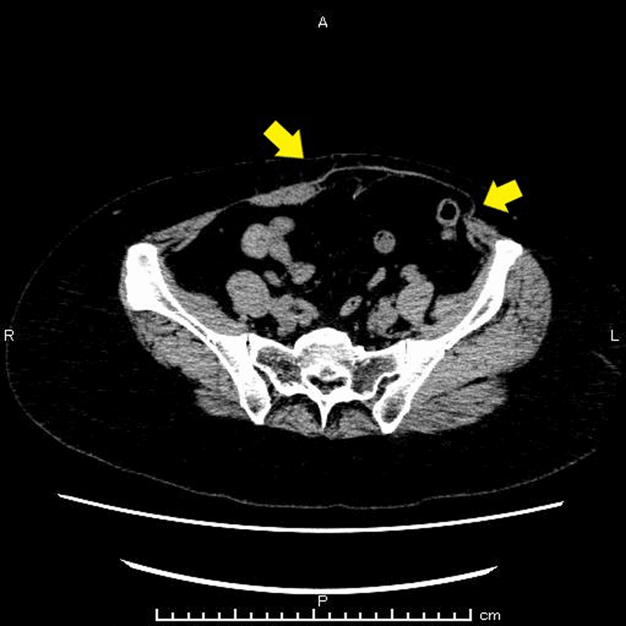 The enhanced-view totally extraperitoneal repair of abdominal bulge after DIEP flap breast reconstruction for breast cancer: a case report