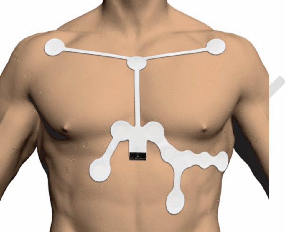 PATCH (Preferred Attachment Strategy for Optimal Electrocardiograms)-1 Study