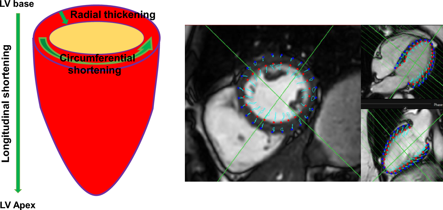 Chronic kidney disease is related to impaired left ventricular strain as assessed by cardiac magnetic resonance imaging in patients with ischemic cardiomyopathy