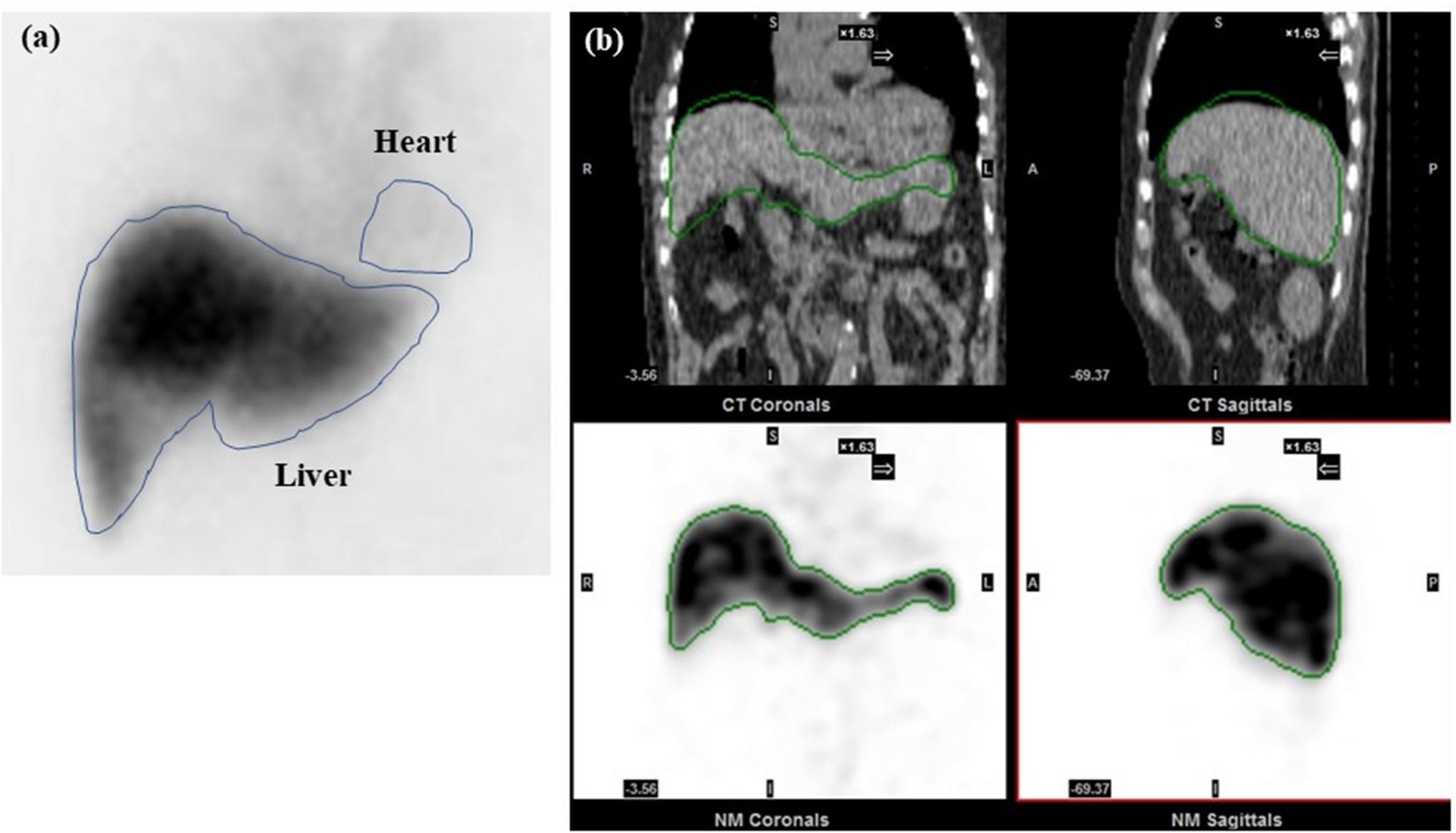 Utility of Quantitative Assessment of Tc-99m-diethylenetriamine-penta-acetic acid-galactosyl Human Serum Albumin SPECT/CT in the Identification of Severe Liver Fibrosis: Its Complementary Diagnostic Value with Other Liver Function Indices