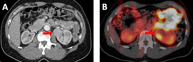 Imaging of Chromophobe Renal Cell Carcinoma with 99mTc-Sestamibi SPECT/CT: Considerations Regarding Risk Stratification and Histologic Reclassification