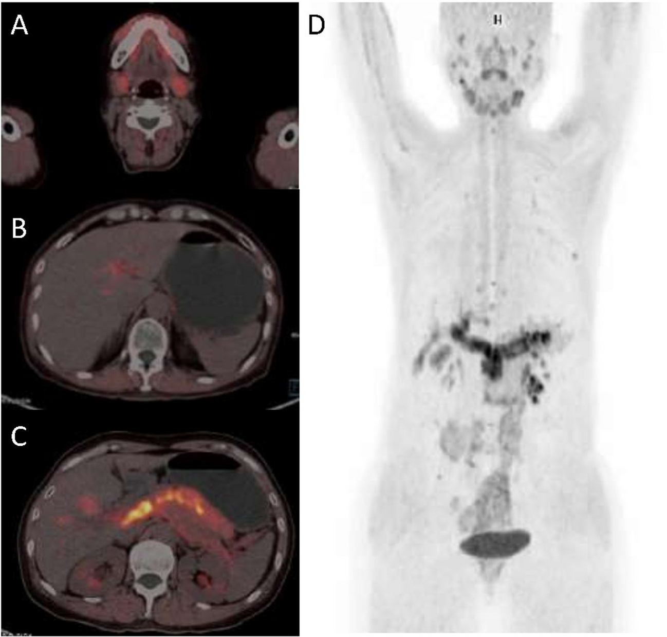 Volume-Based Quantitative Measurement of [18F]AlF-NOTA-FAPI-04 PET/CT Uptake Reflects the Disease Activity of IgG4-Related Disease