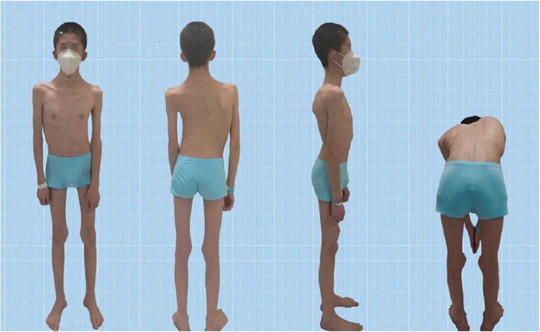 Nemaline myopathy with scoliosis: a case report