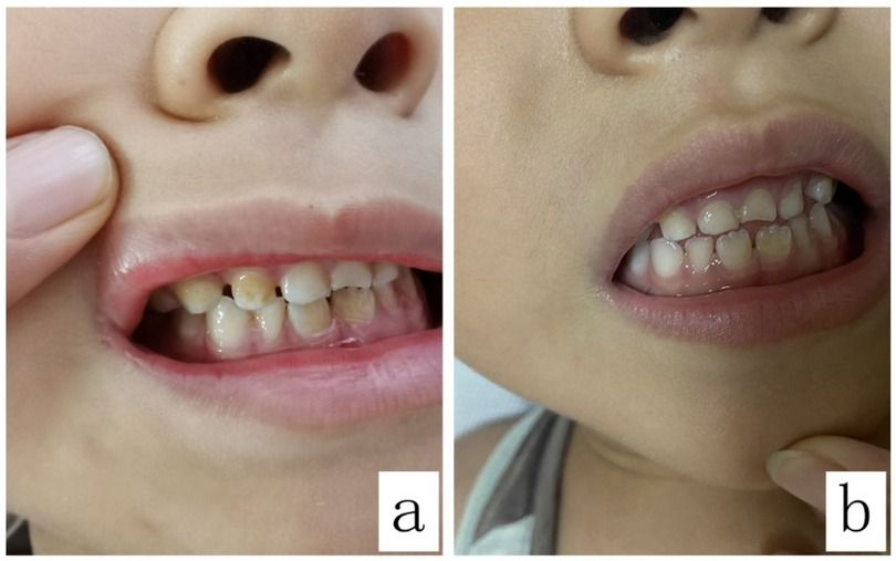 Case Report: A case study and literature review on teeth discoloration caused by linezolid with the shortest incubation period in a pediatric patient