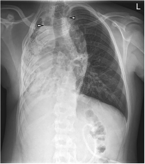 Case Report: Esophageal squamous cell carcinoma in a 13-year-old boy with a history of esophageal atresia with tracheoesophageal fistula