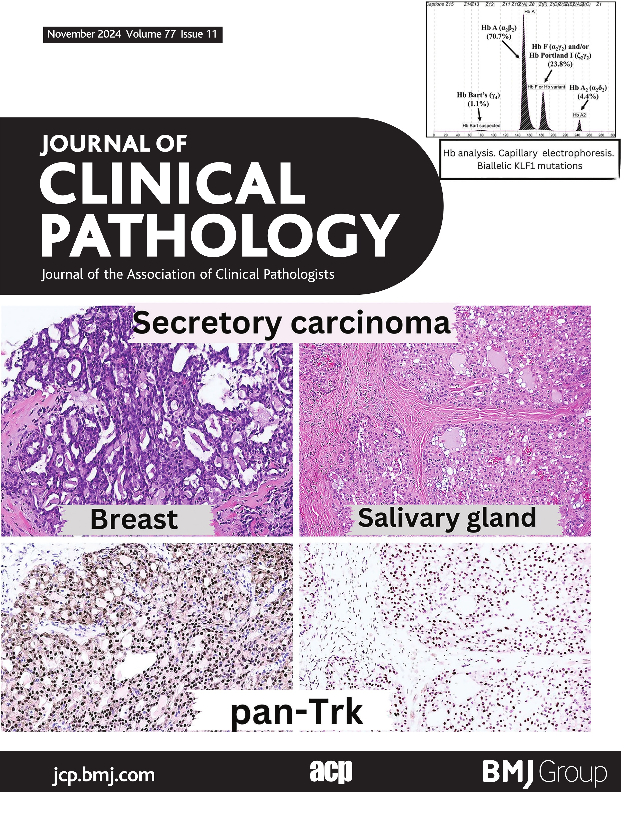 Molecular and haematological characterisation of haemolytic anaemia associated with biallelic KLF1 mutations: a case series