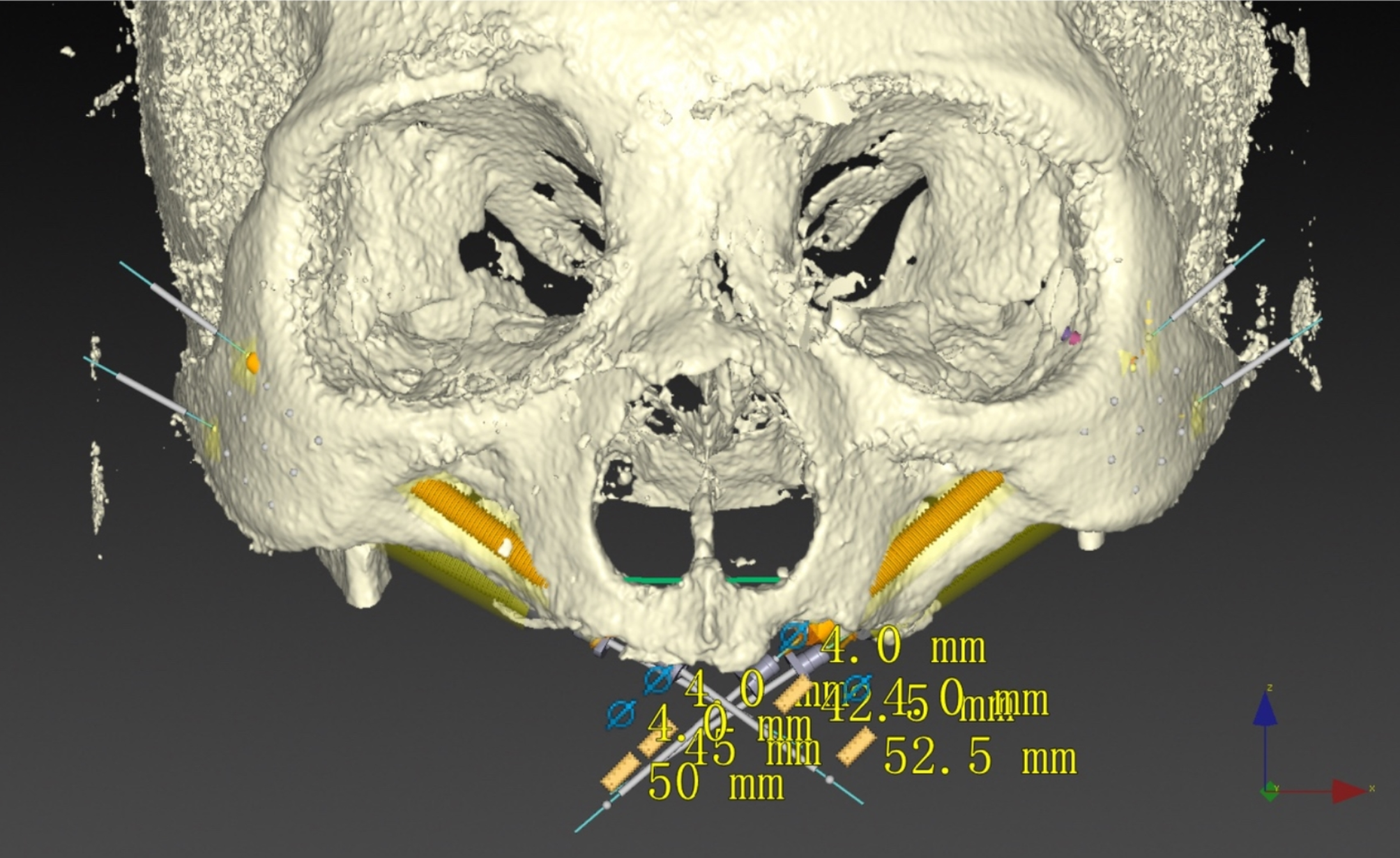 The optional apex sites for quad zygomatic implant placement in edentulous patients with severe alveolar bone resorption: a CBCT anatomical analysis