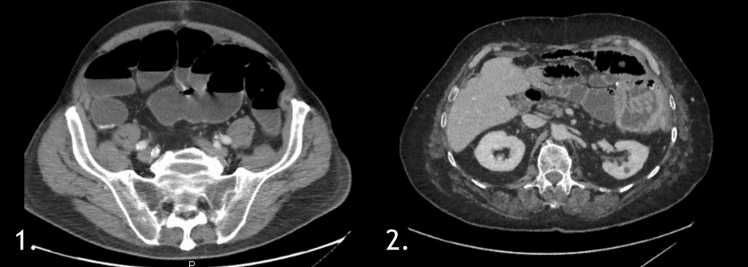 Foreign body granuloma caused by gauze fibers: a rare cause of chronic postoperative ileus following cytoreductive surgery for pseudomyxoma peritonei