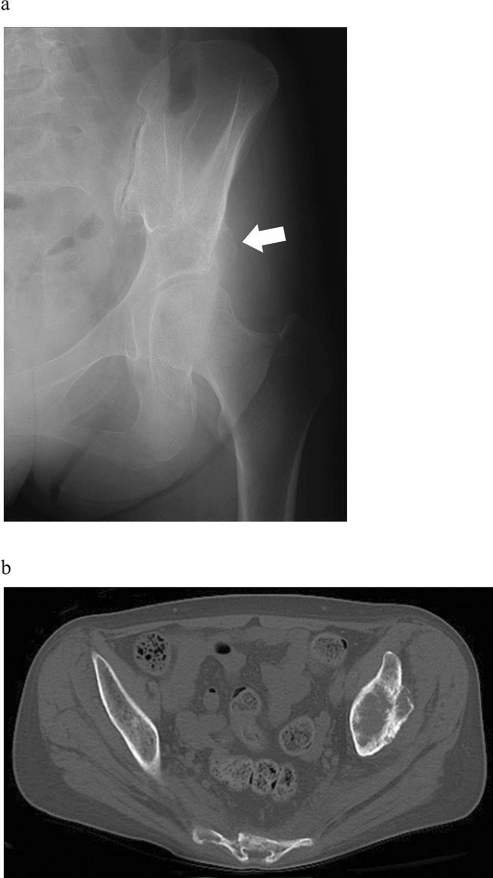 Mini-open periacetabular cementoplasty for periacetabular bone metastasis: a report of two cases