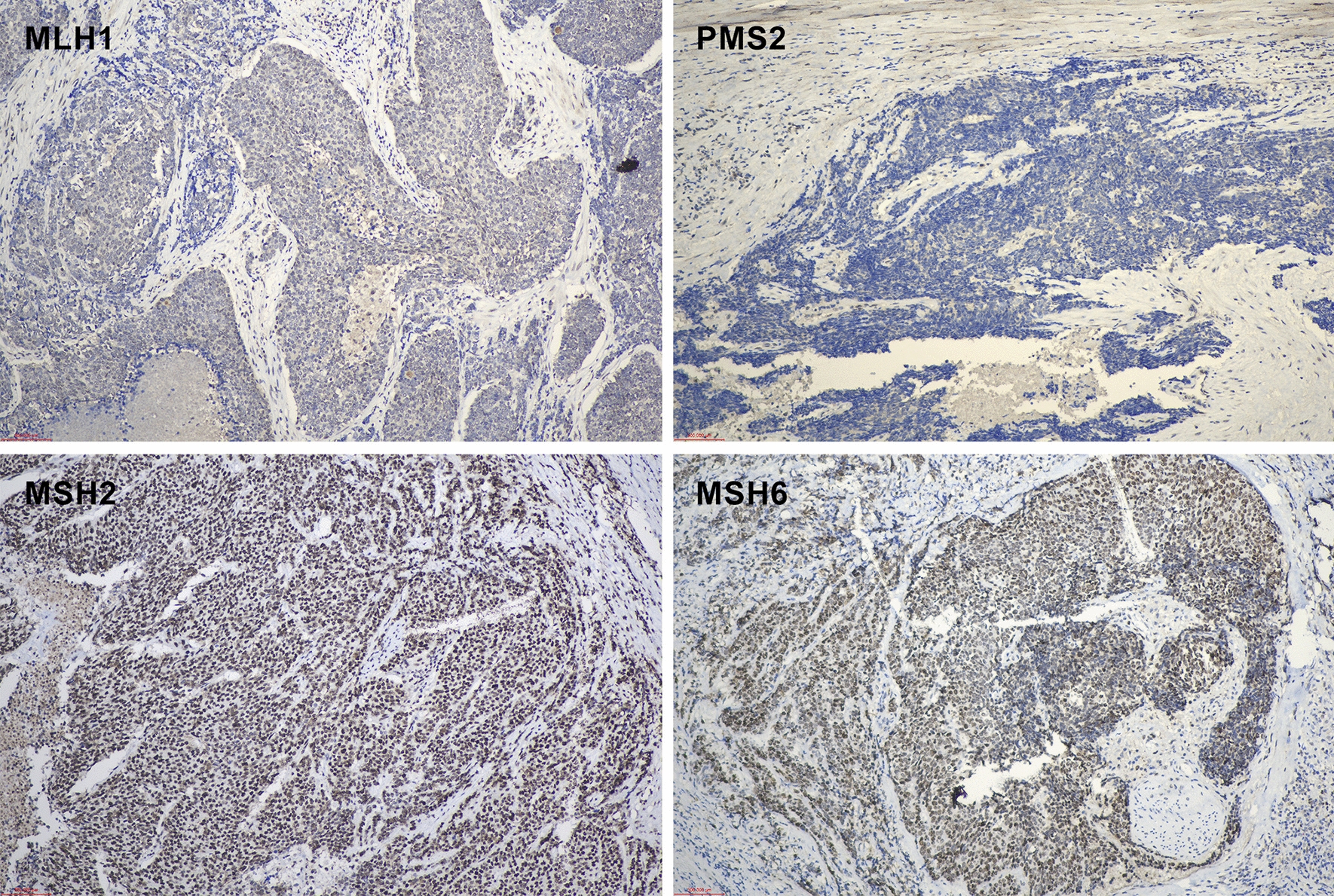 Prostate ductal adenocarcinoma with MLH1 copy number loss, microsatellite instability high and BRCA2 mutation