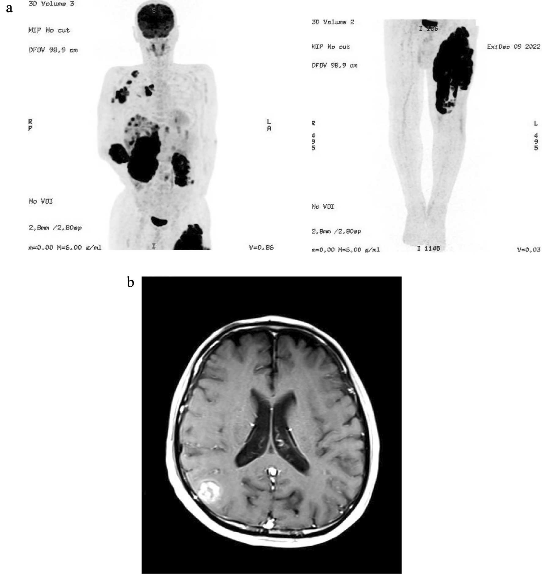 SMARCA4-deficient epithelioid sarcoma revealed by comprehensive genomic profiling, leading to a notable response by nivolumab treatment