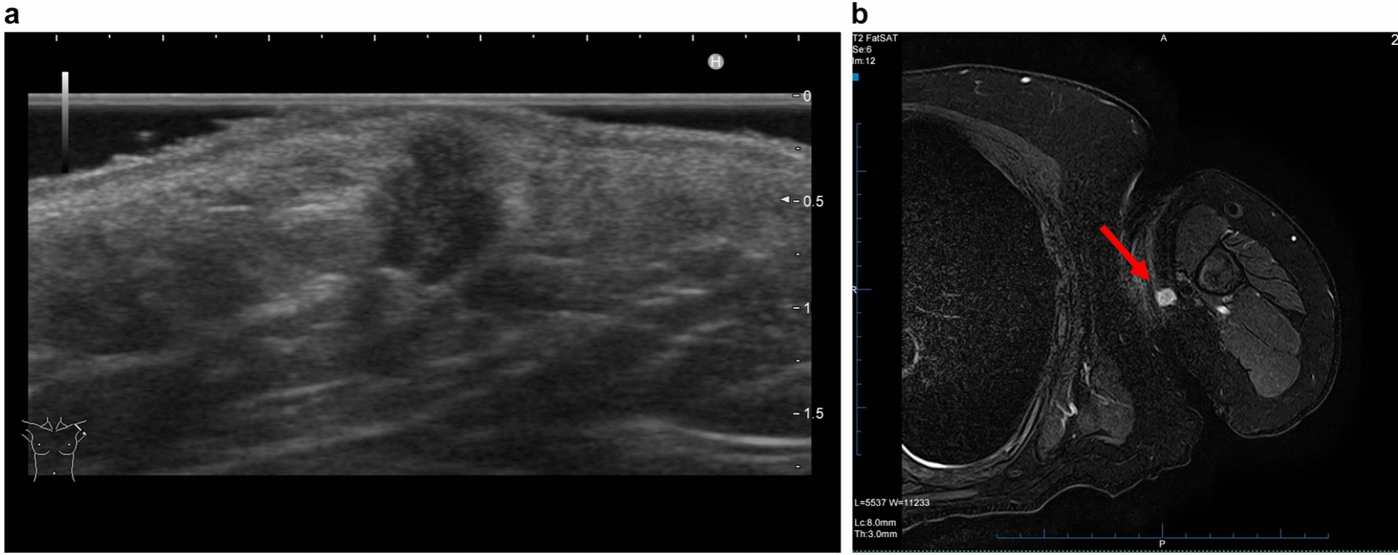 Treatment of HER2-positive cutaneous apocrine carcinoma of the axilla