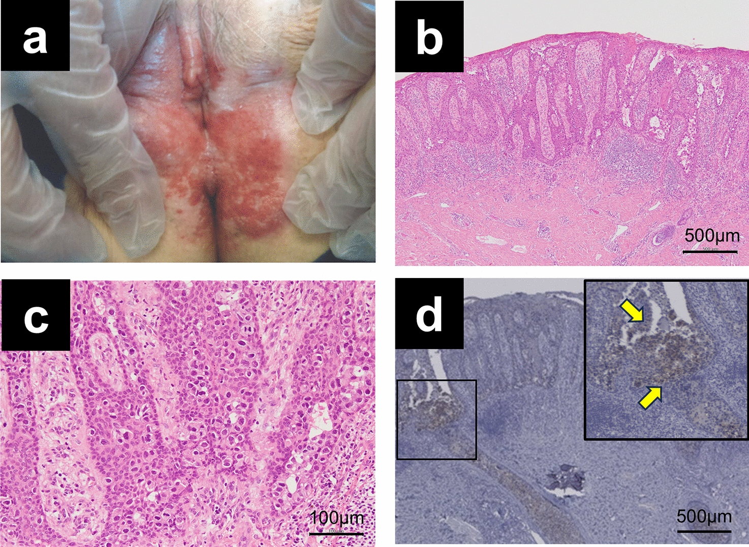 A case of pagetoid spread of urothelial carcinoma with notable reduction achieved through enfortumab vedotin, resulting in complete surgical resection