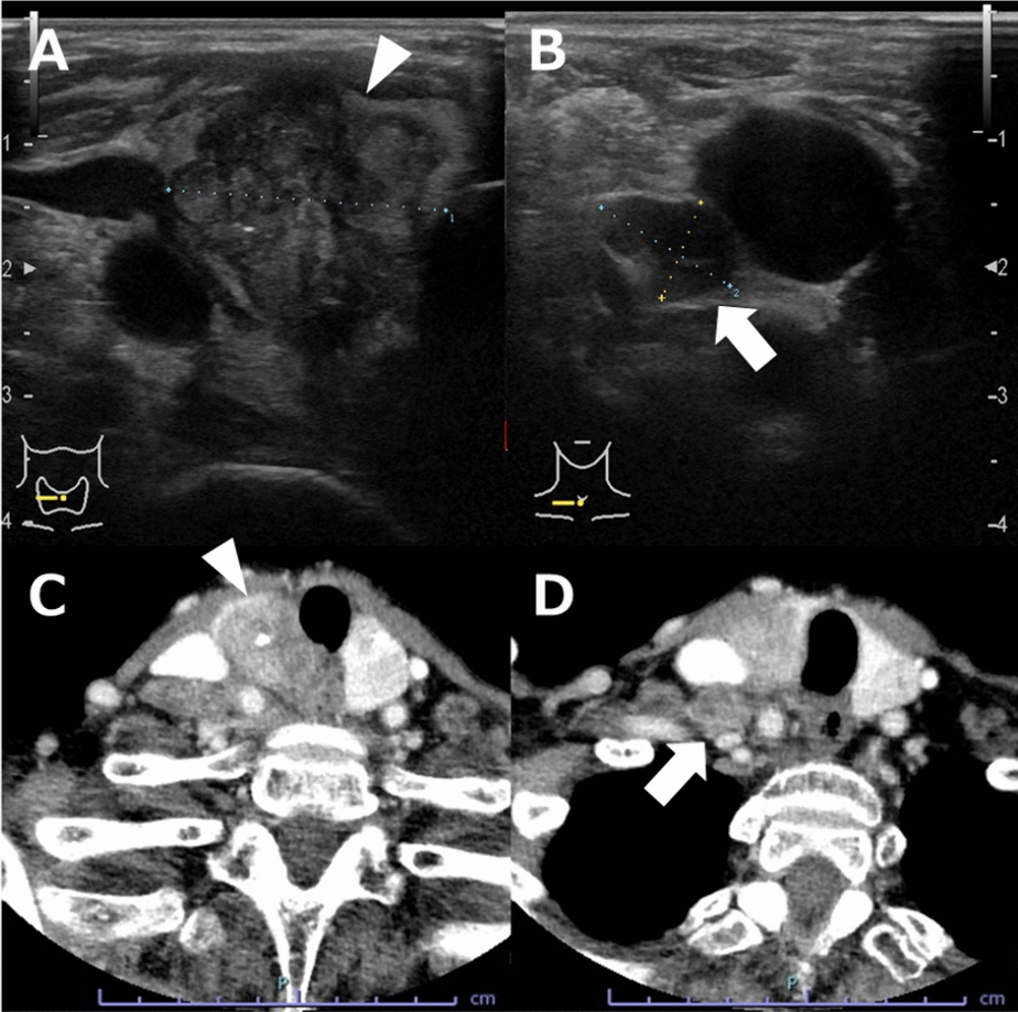 A case of selpercatinib treatment for anaplastic thyroid carcinoma resulting in abscess formation