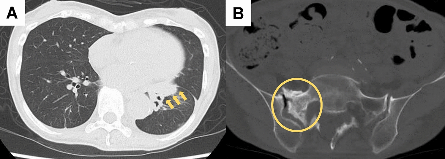 Ileal perforation at the site of peritoneal metastasis with intestinal infiltration by dual EGFR-VEGF pathway inhibition in an EGFR-mutant non-small cell lung cancer patient