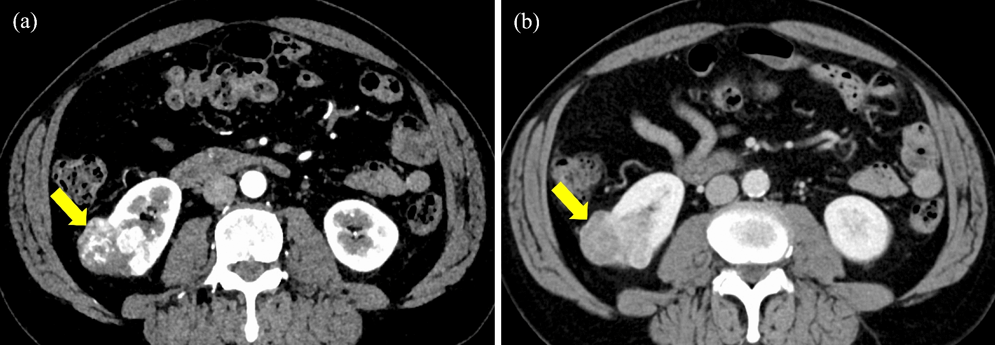 Reduction of bleeding by cabozantinib in metastatic renal cell carcinoma with hereditary hemorrhagic telangiectasia