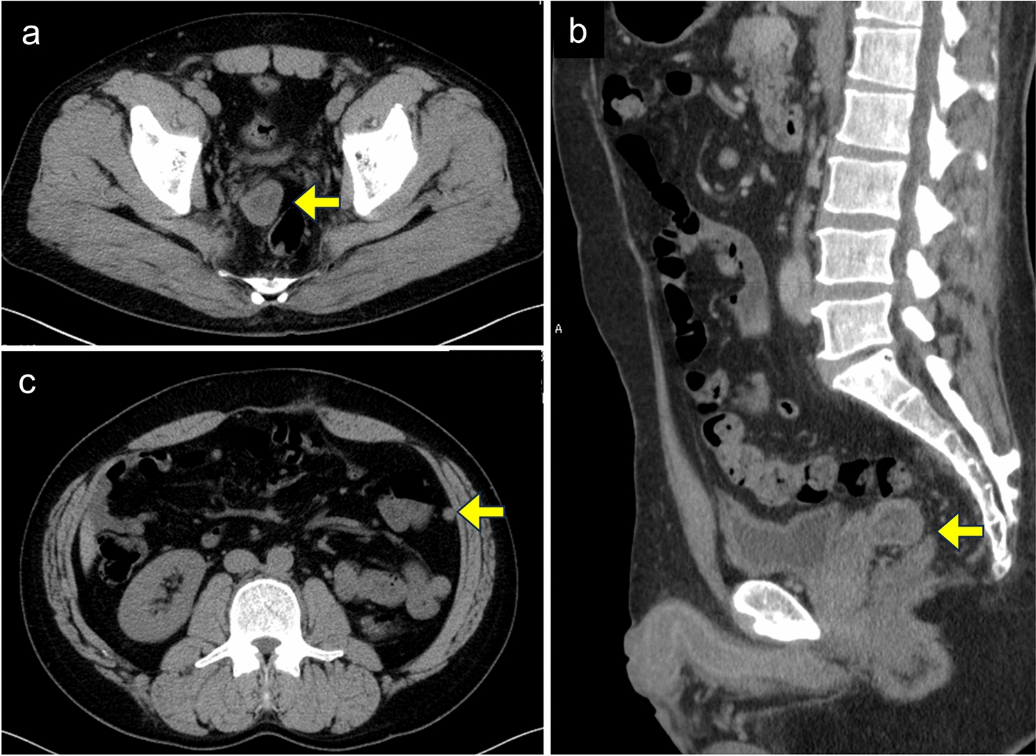 A case of uncommon metastasis located posterior to the seminal vesicles in renal cell carcinoma