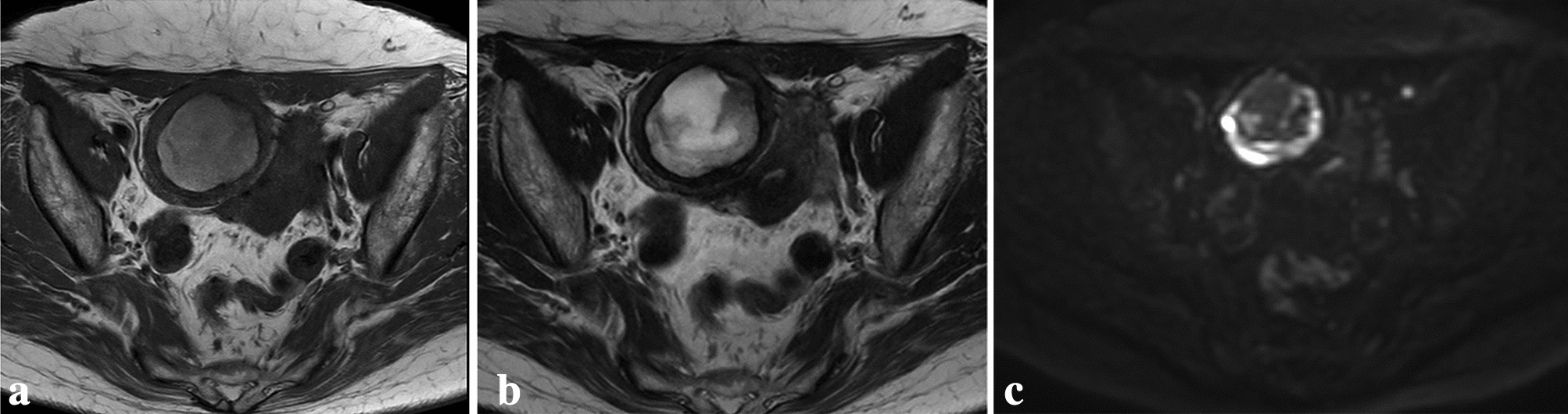 Phosphoglyceride crystal deposition with suspected malignant ovarian tumor: a case report and literature review