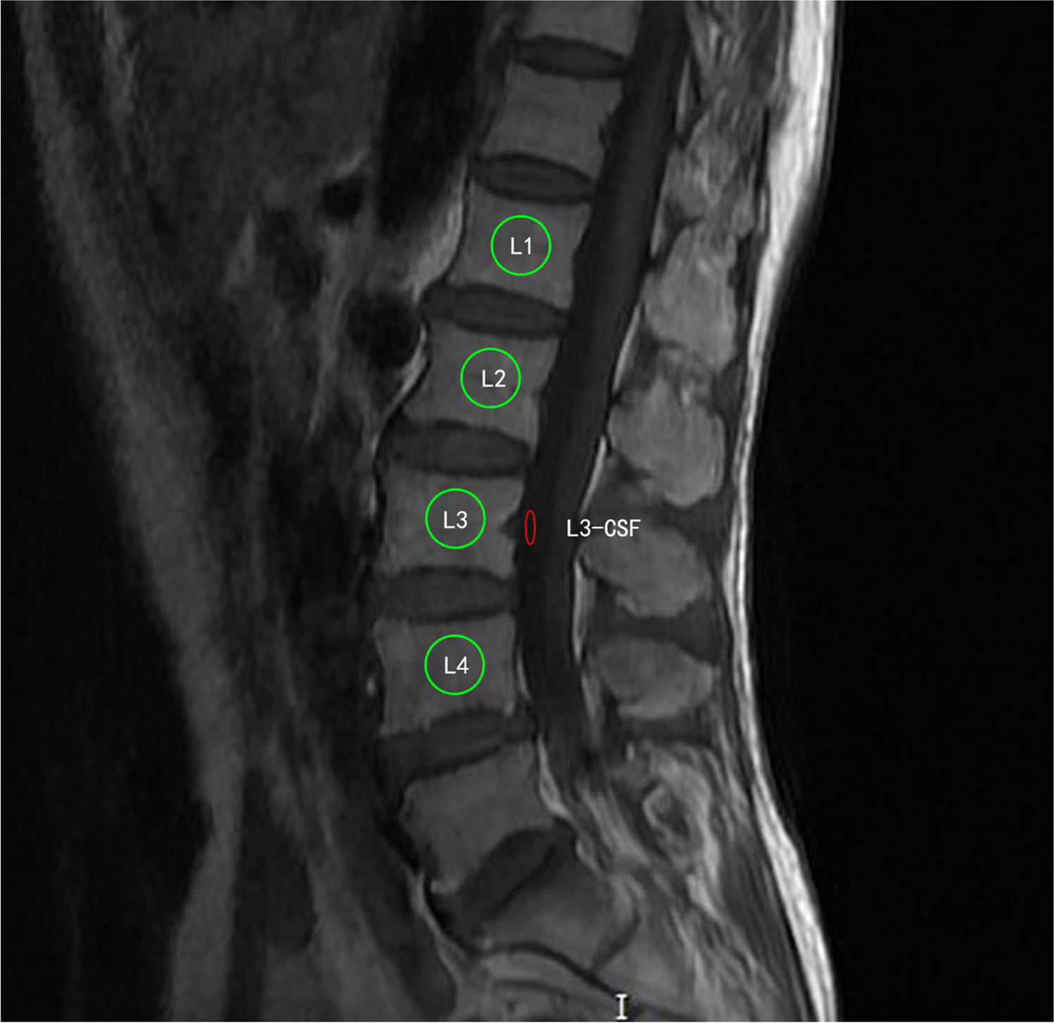 The diagnostic value of MRI-based vertebral bone quality score for osteoporosis or osteopenia in patients undergoing lumbar surgery: a meta-analysis