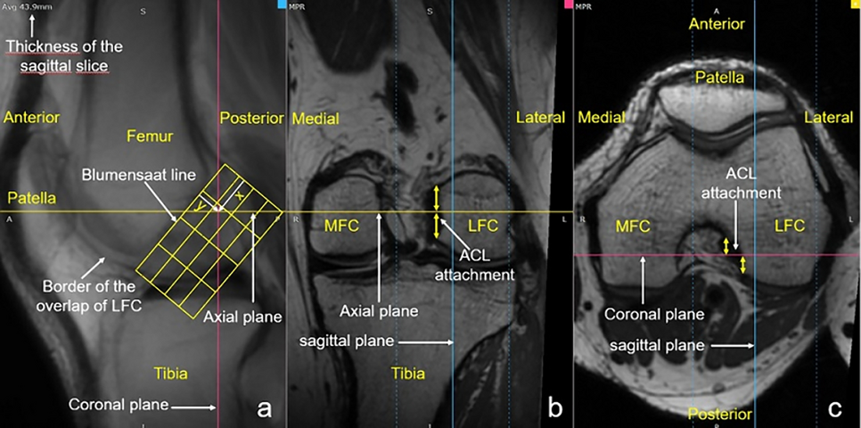 Location of the Anatomic Footprint Centers of the Anterior Cruciate Ligament Determined by Quadrant Method on Three-Dimensional Magnetic Resonance Imaging