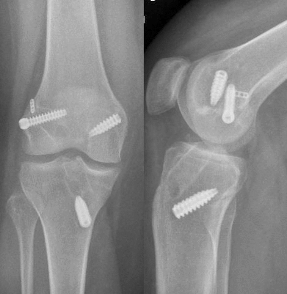 Technology Update in Management of Multi-Ligament Knee Injuries