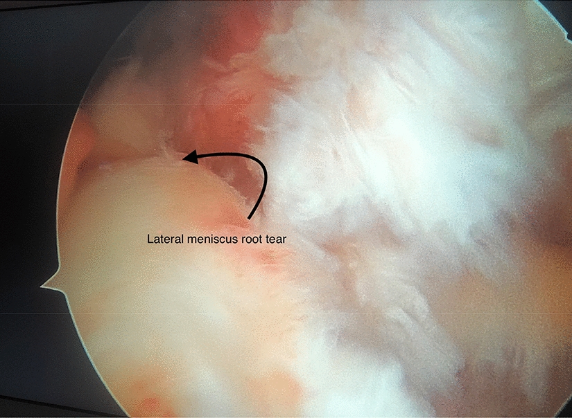 Intra-Tunnel Knotless Anchor Fixation for Lateral Meniscus Posterior Root Tears: A Novel Technique