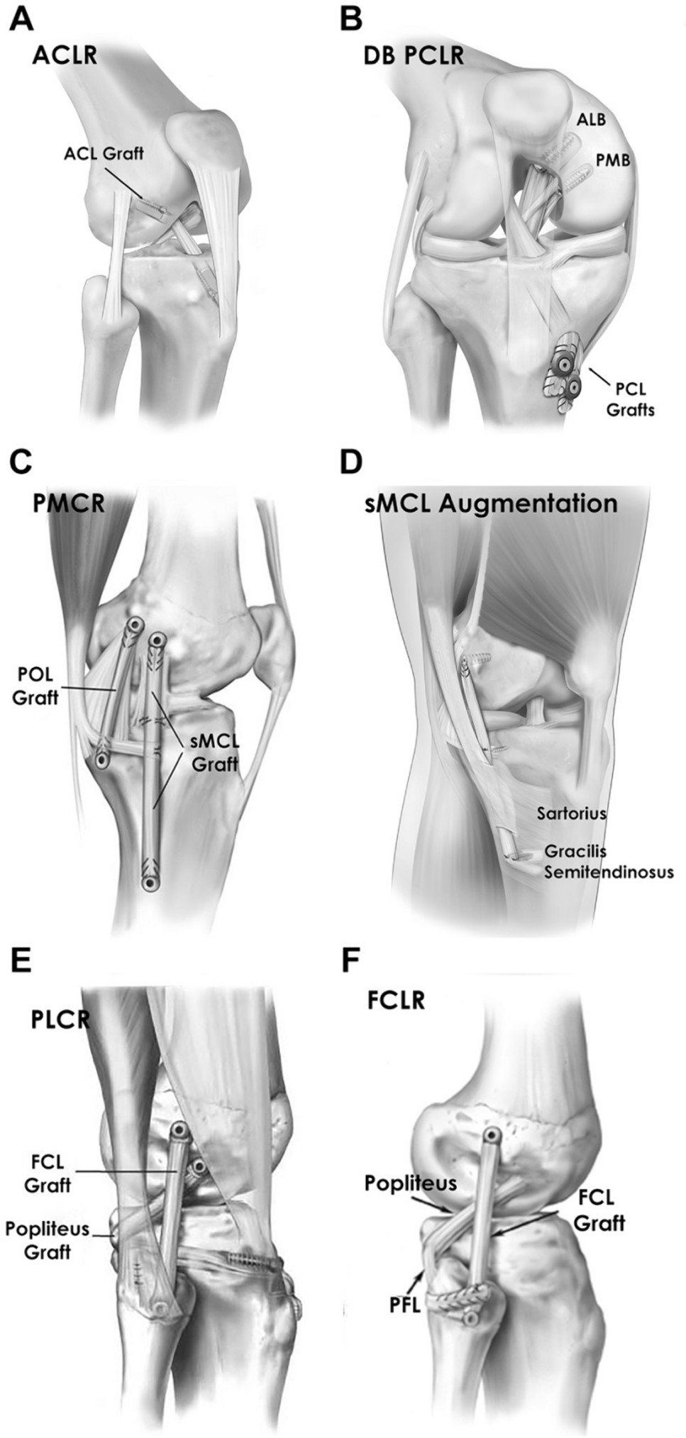 Strategies for Preventing Tunnel Convergence in Multiligament Knee Injury Reconstructions