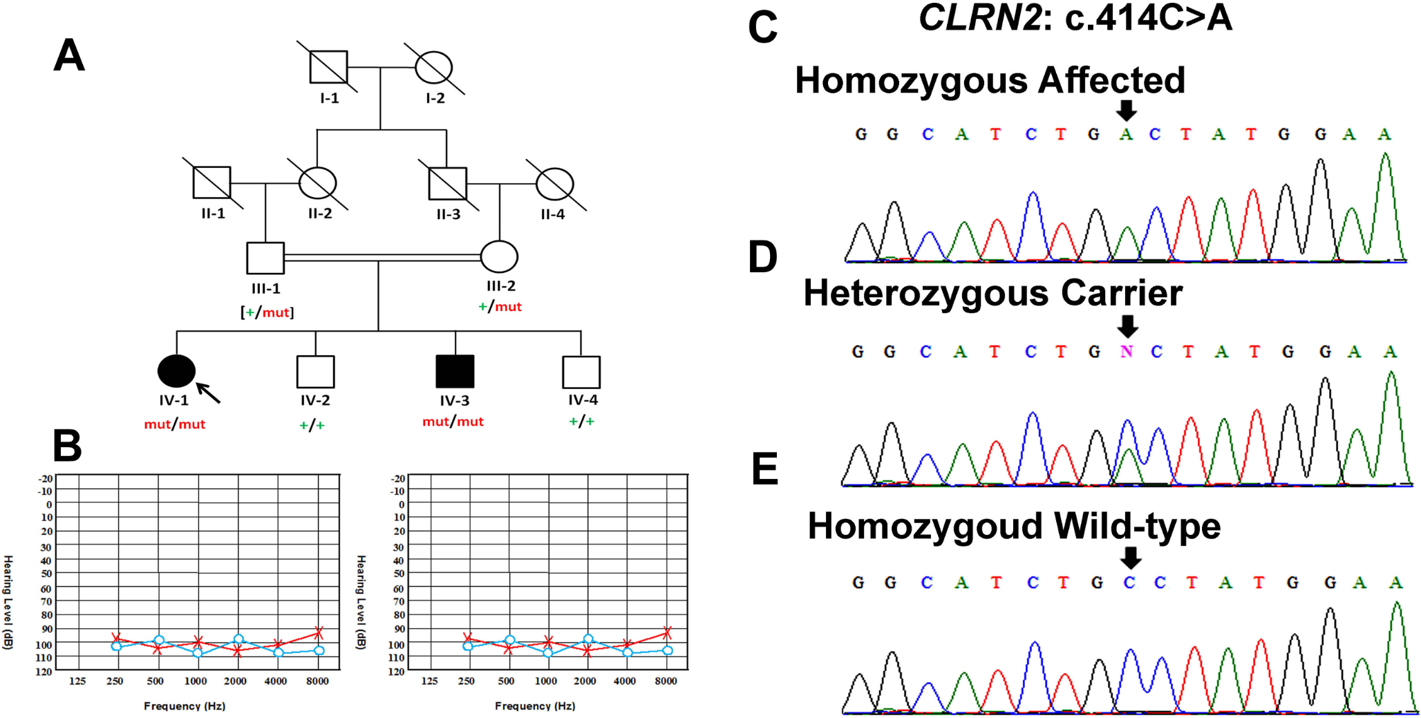 A novel CLRN2 variant: expanding the mutation spectrum and its critical role in isolated hearing impairment