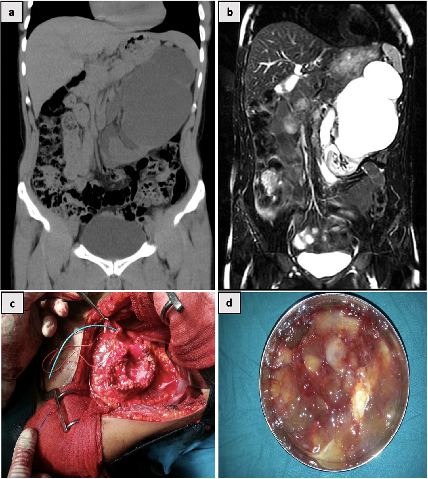 Mucinous adenocarcinoma in kidneys with developmental anomalies - a report of two cases