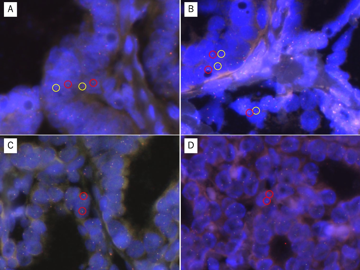 Correlation between gene mutations and clinical characteristics in papillary thyroid cancer: a retrospective analysis of BRAF mutations and RET rearrangements