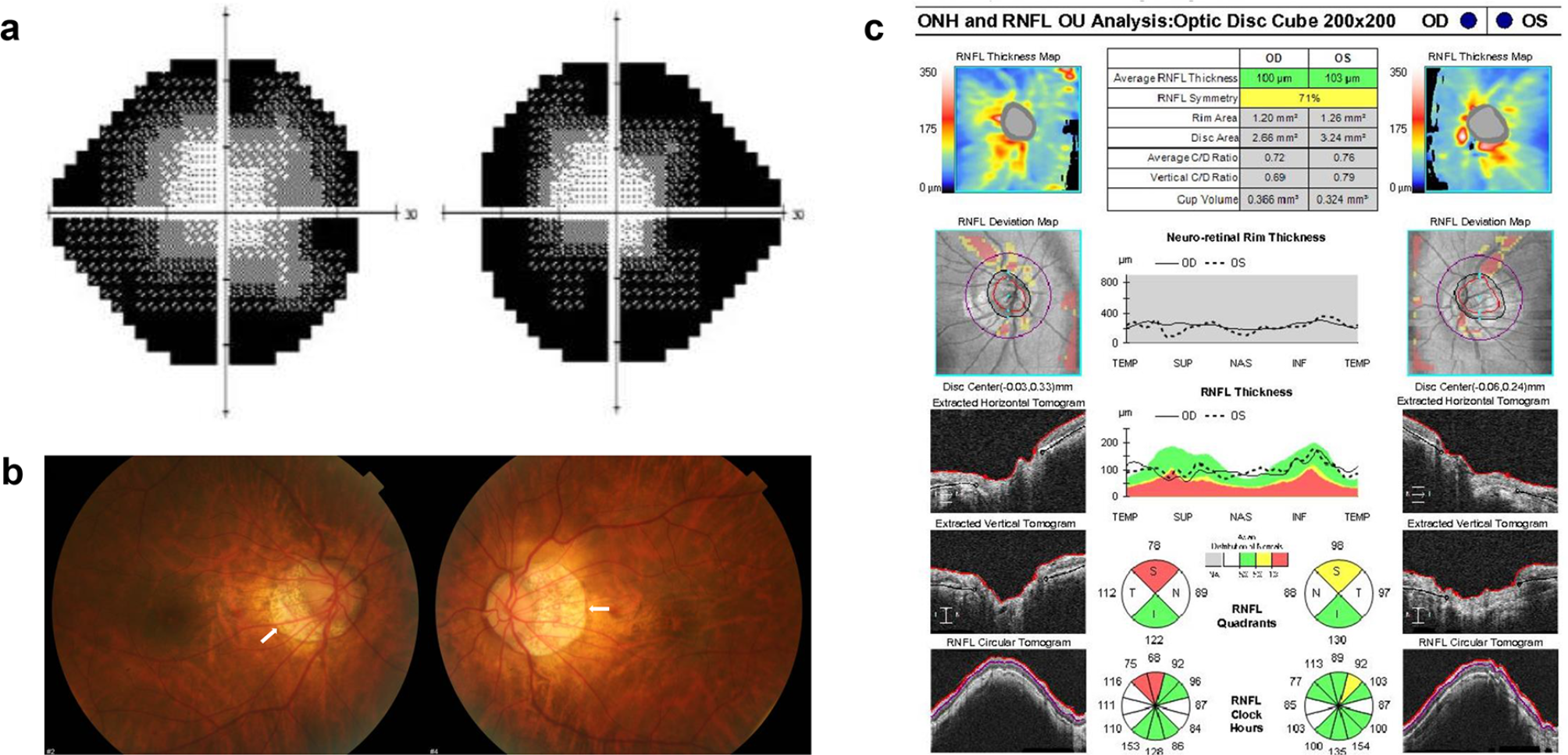 Challenges in identifying papilledema amid myopic peripapillary atrophy in a patient with idiopathic intracranial hypertension and high myopia: a case report