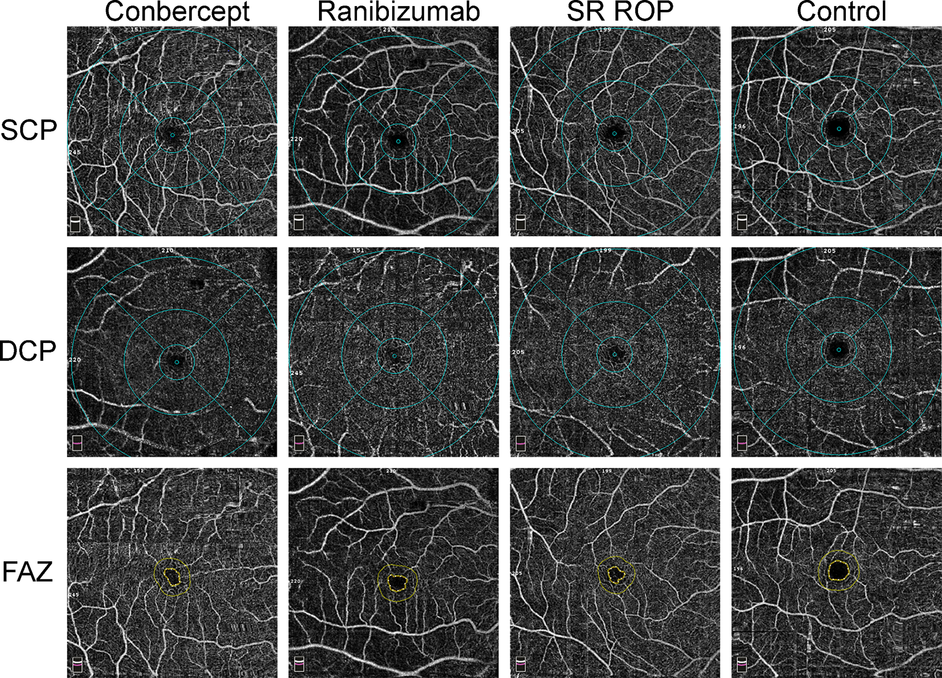 The analysis of foveal microvascular anomalies in retinopathy of prematurity after anti-vascular endothelial growth factor therapy using optical coherence tomography angiography