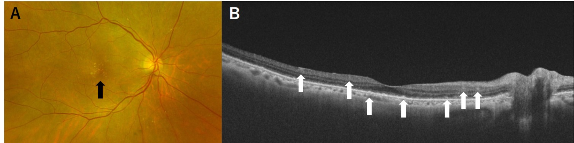 A rare case of infiltrative optic neuropathy caused by vitreoretinal lymphoma with hyperreflective deposits in the intraretinal and subretinal pigment epithelial layers prior to the disease onset