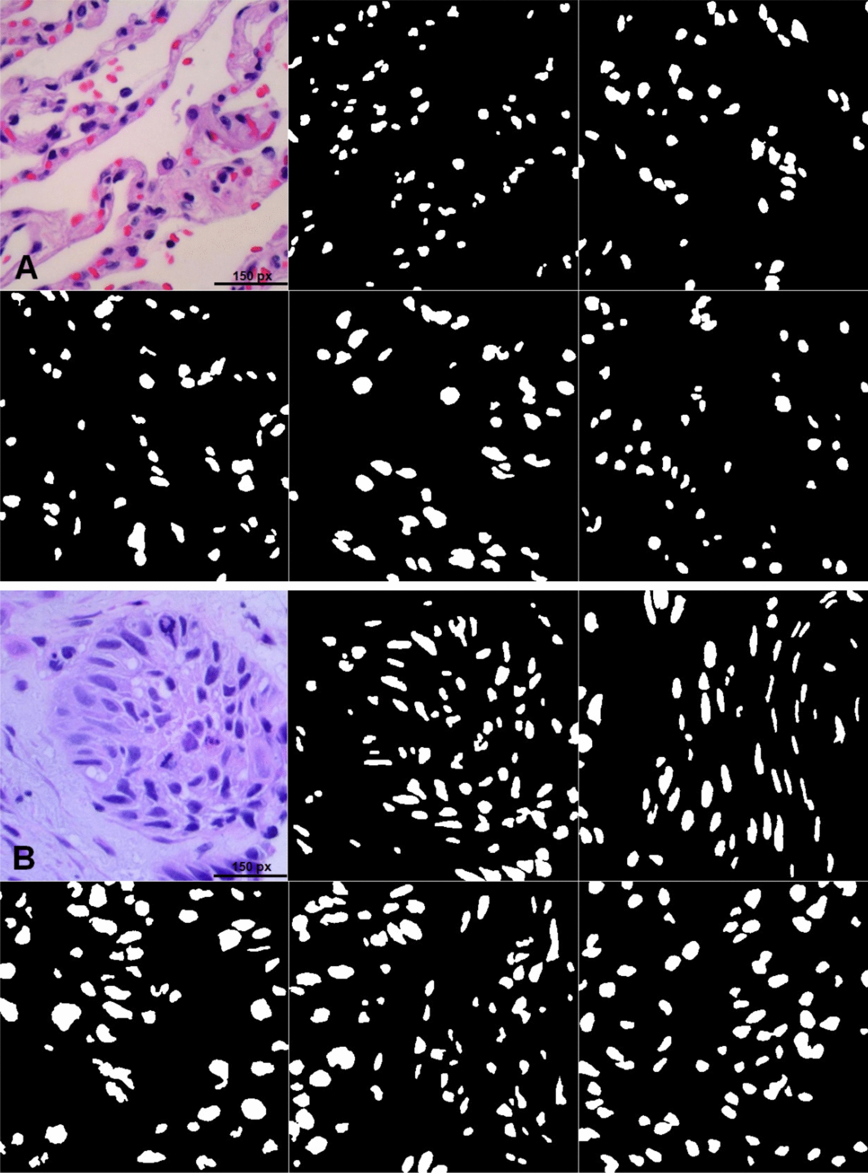 Complex shape markers can detect alterations in the spatial distribution of cell nuclei in human lung squamous cell carcinoma: a useful tool for automatic analysis?