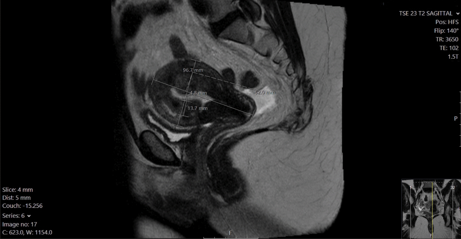 Interventional Radiology Treatments to Address Chronic Pelvic Pain in Females