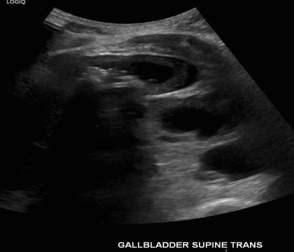 Percutaneous Gallstone Extraction Through Midbody Access to the Gallbladder Using a Cleaner XT Rotational Thrombectomy Device: A Case Report