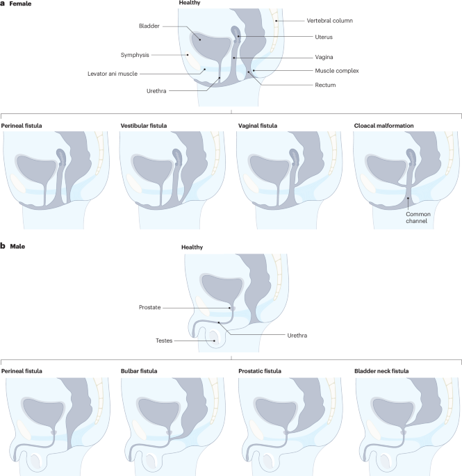 Anorectal malformations