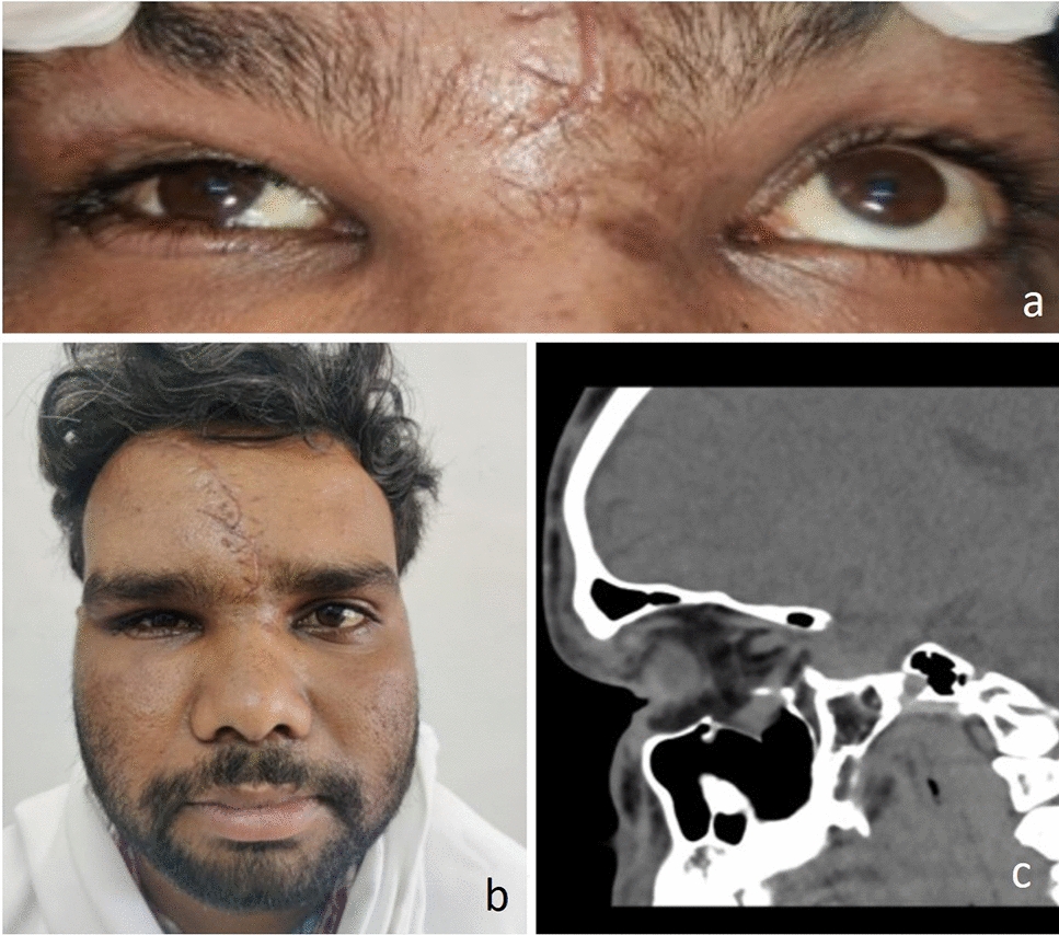 Combined Open Reduction and Transantral Endoscopic Approach for Internal Fixation of Orbital Floor Fractures: A Tertiary Care Center Experience with Decision-Making Algorithm