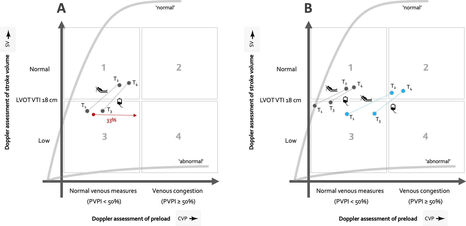 Passive leg raising uncovers venous congestion: dynamic fluid intolerance and the Doppler Starling curve