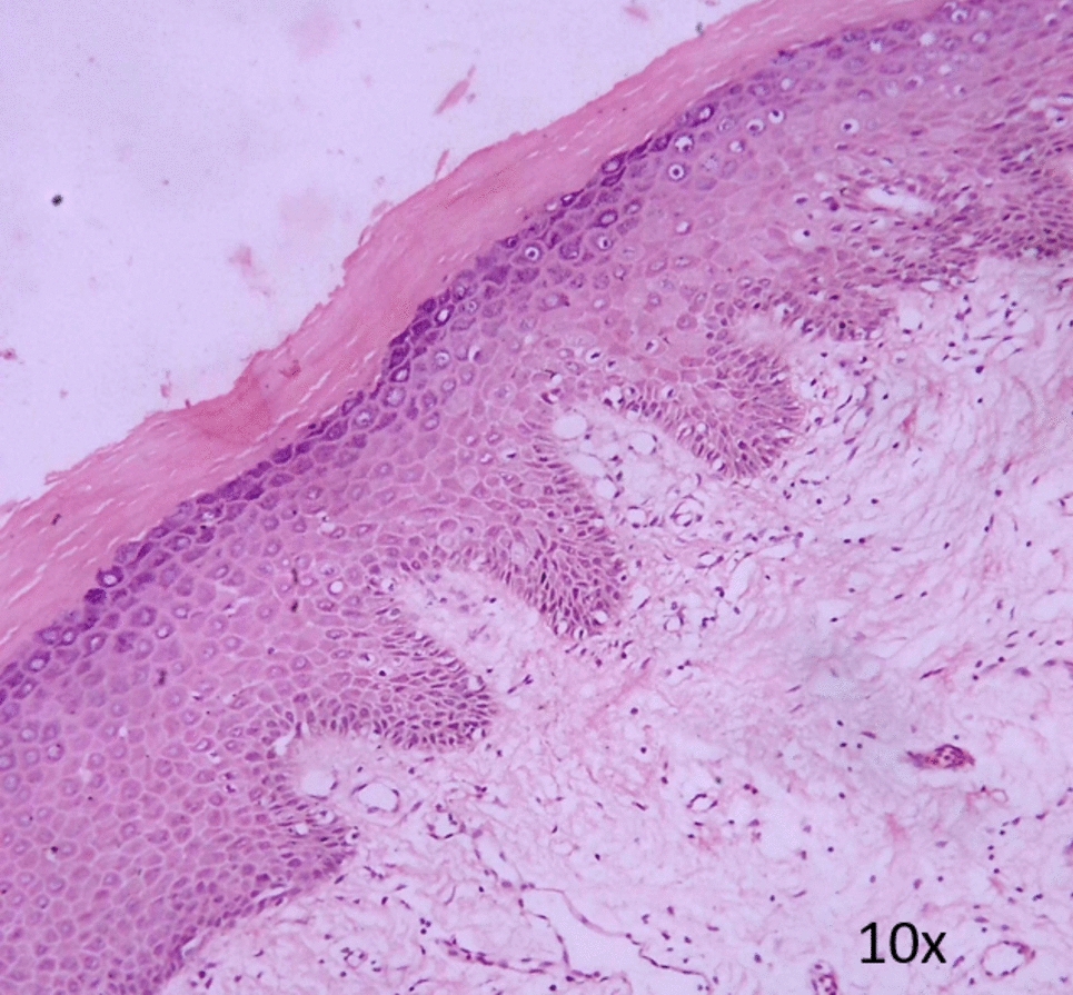 Interobserver Variability in Reporting Oral Dysplasia: Sources of Variability and Strategies to Minimize