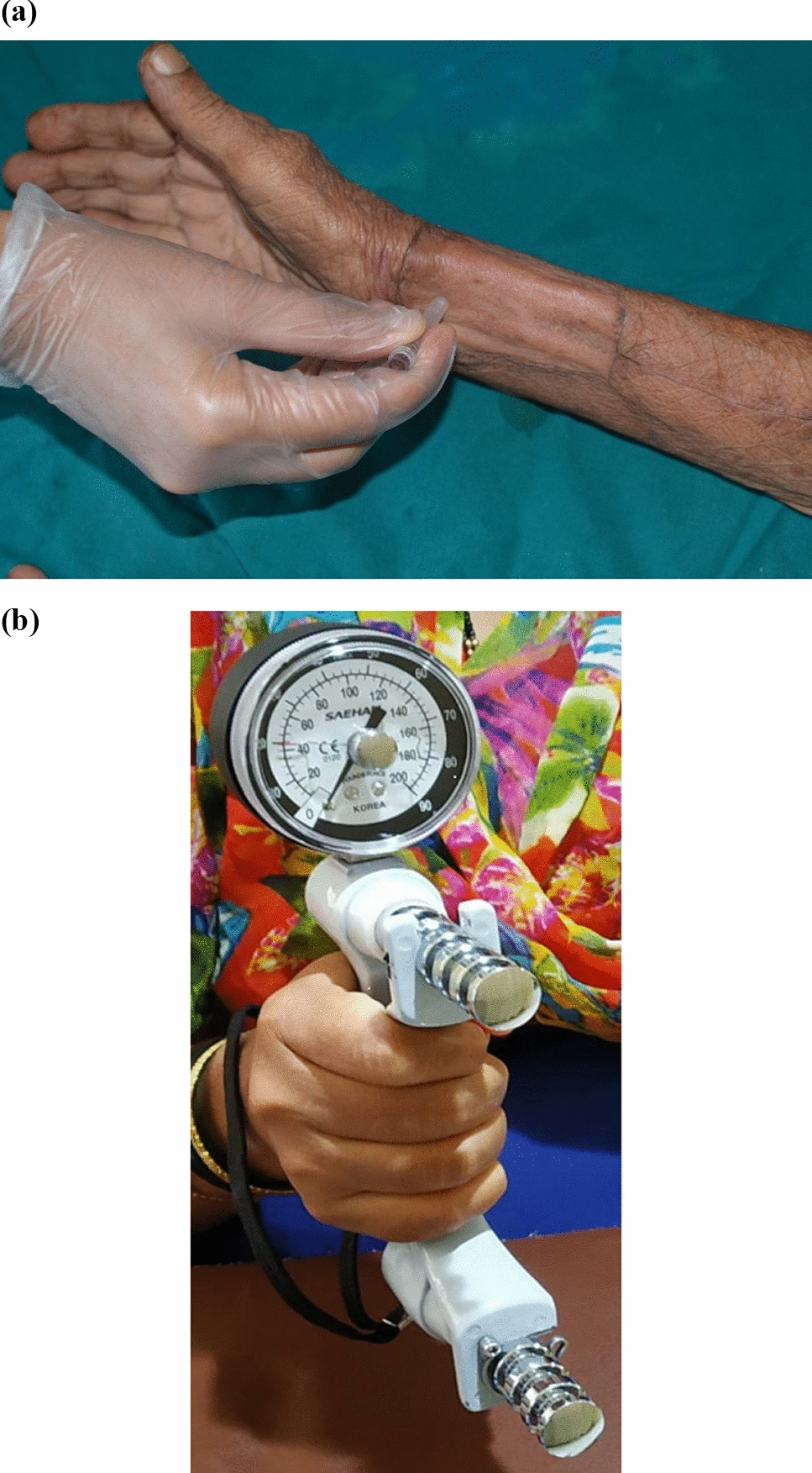 Assessment of Quality of life and Donor site morbidity following reconstruction in oral cancer patients-A prospective study