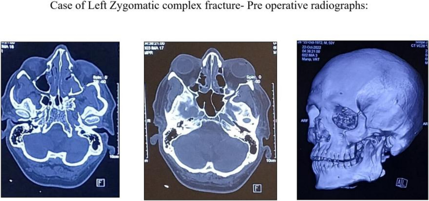 The Effect of Lag Time Between Injury and Treatment of Zygomatic Complex Fractures on the Neurosensory Disturbances of the Infraorbital Nerve