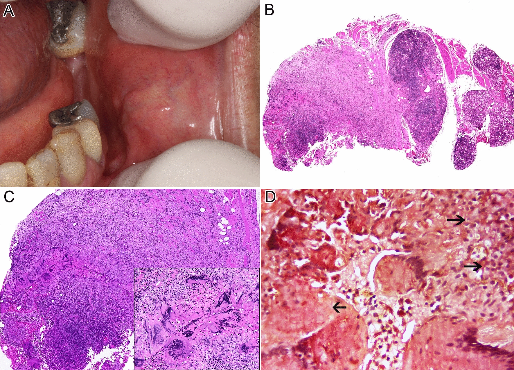 Intraoral Foreign Body-Type Giant Cell Reaction in a Sjögren’s Syndrome Patient: An Immunohistochemical Analysis