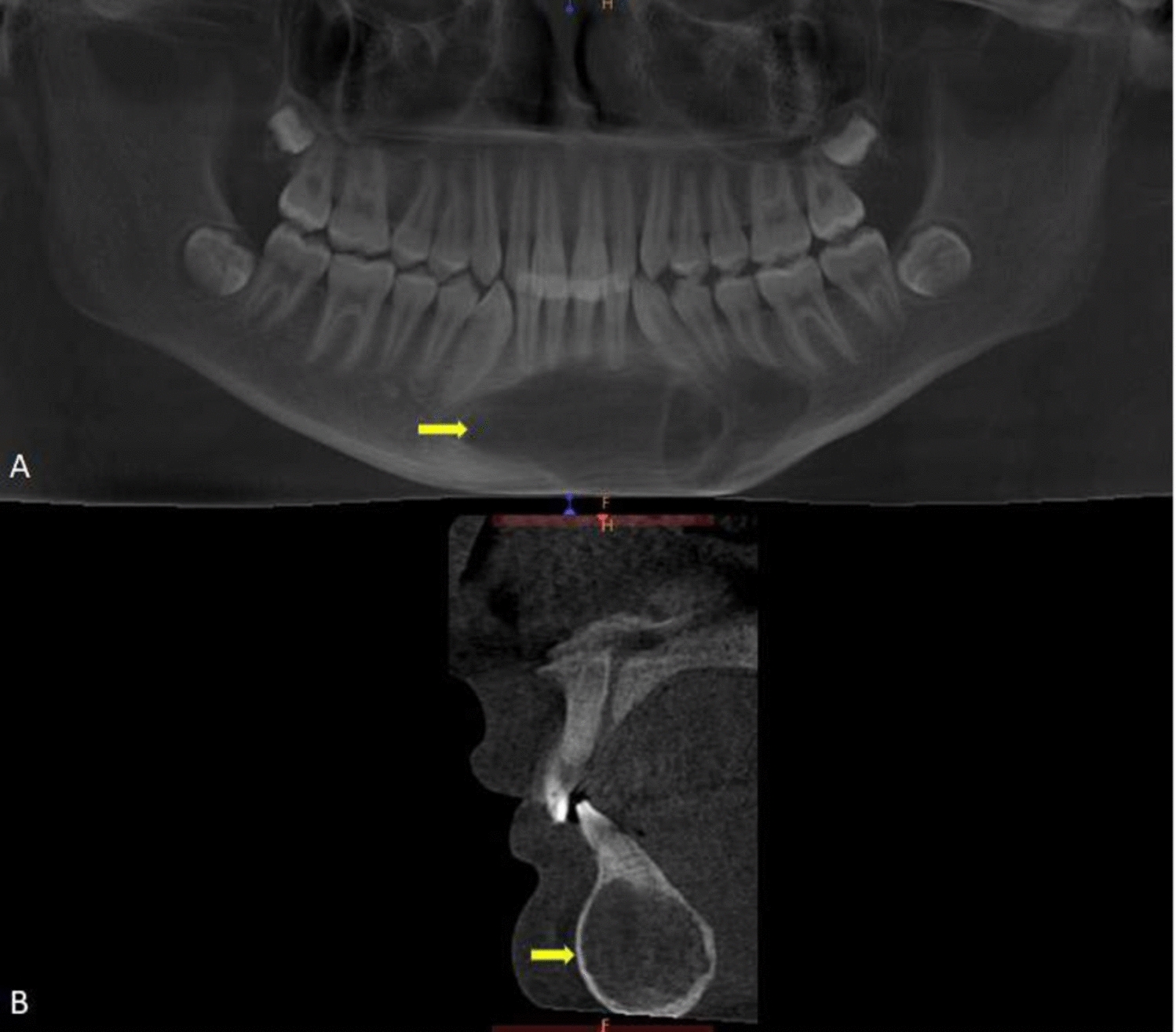 Surgical and Anesthetic Considerations in the Management of Ossifying Fibroma of the Mandible with Congenital Factor VII Deficiency: A Case Report and Literature Review