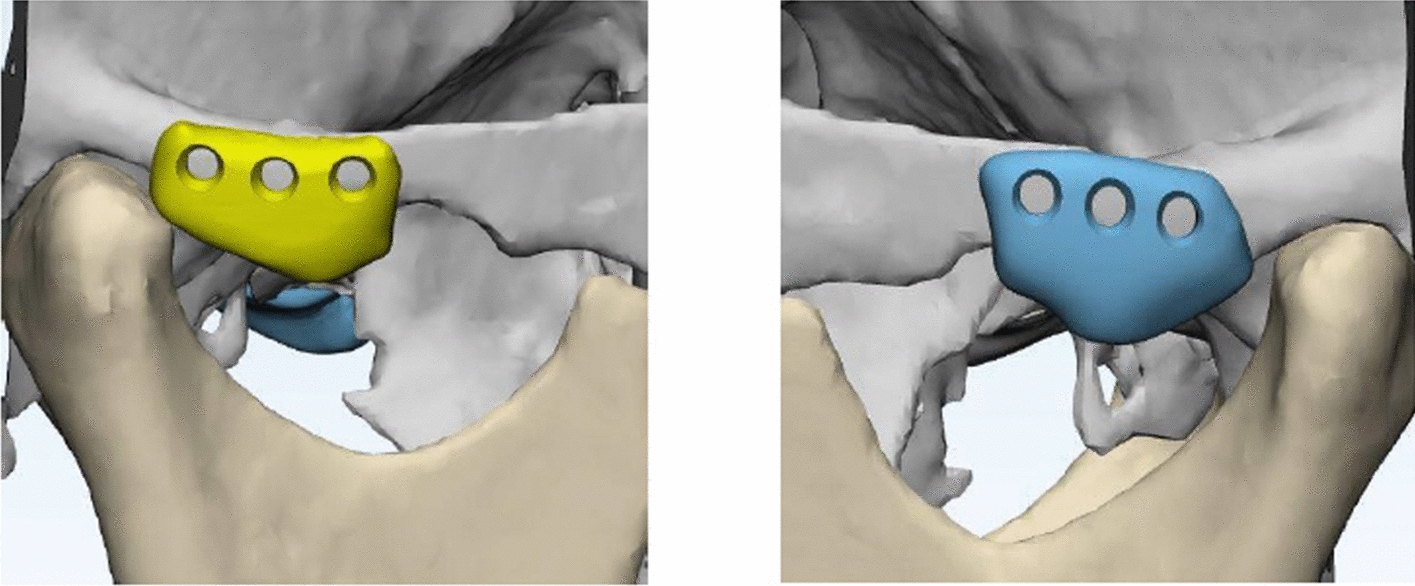 Patient-Specific Polyether-Ether Ketone (PEEK) Onlay Eminoplasty (PSPOE): A Novel Protocol for Treatment of Recurrent Temporomandibular Joint Dislocation