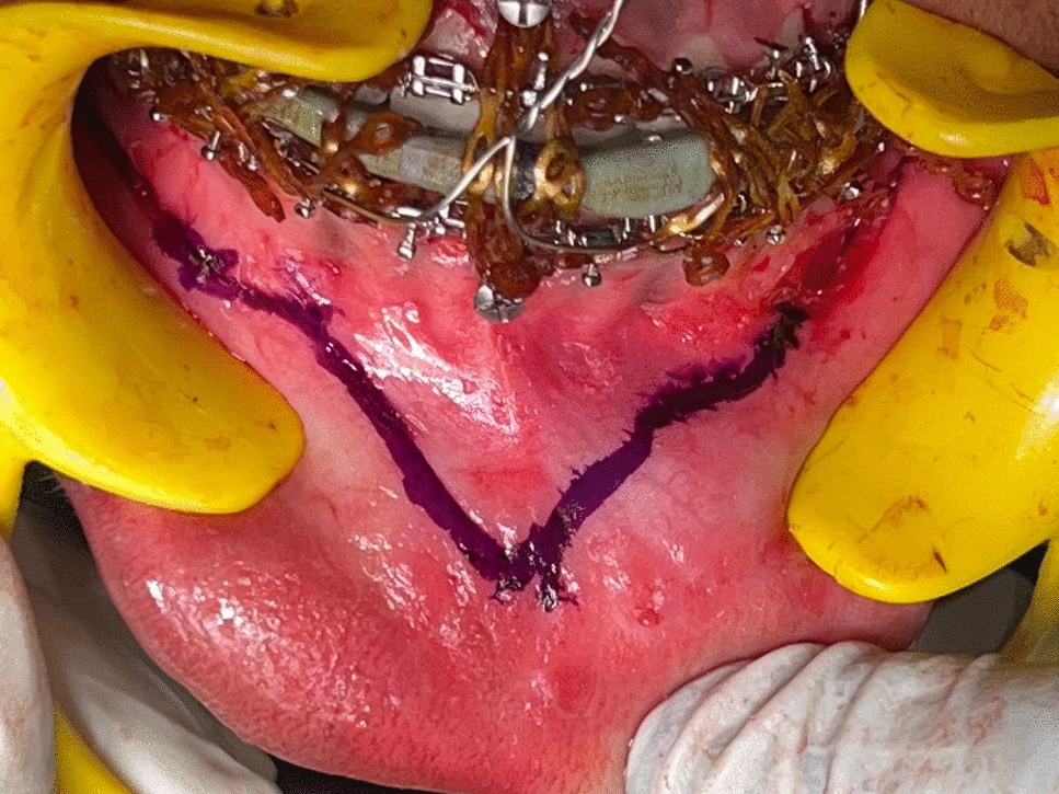 Stealth incision: A Novel Incision Design For Large Advancement Genioplasty